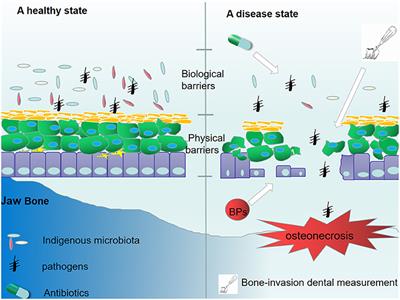 The Role of the Immune Response in the Development of Medication-Related Osteonecrosis of the Jaw